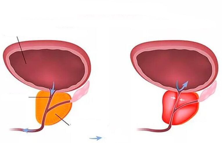 prostata normalna i stan zapalny