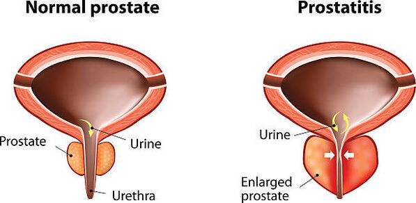prostata normalna i w stanie zapalnym